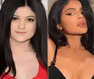 kylie jenner avant chirurgie esthétique