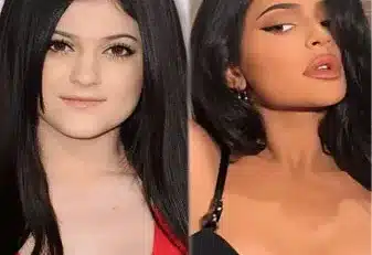 kylie jenner avant chirurgie esthétique