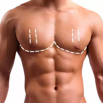 gynecomastie tunisie