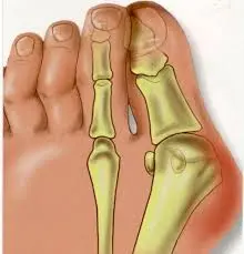 hallux valgus tunisie